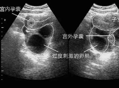 选择哈萨克斯坦试管婴儿的费用影响因素及预算规划建议？